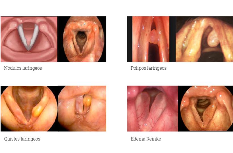 Patologías voz | Cirugía de la voz | Servicios otorrinolaringología | Instituto de Cabeza y Cuello (ICiC)