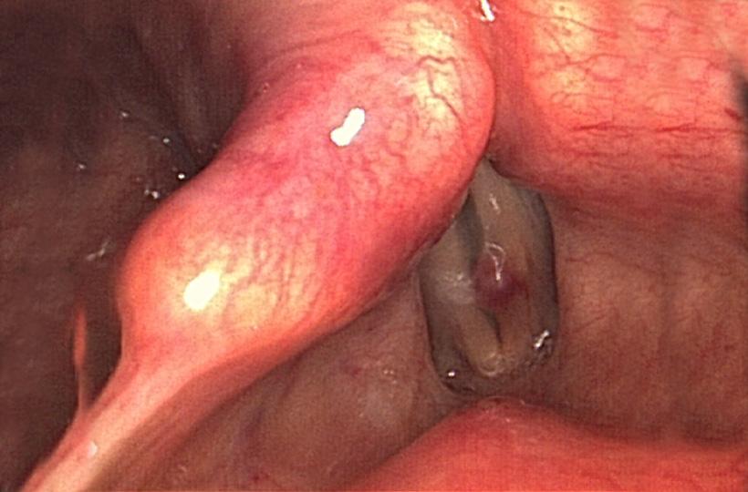 En la imagen se observan unas cuerdas vocales. En la imagen se observan unas cuerdas vocales.