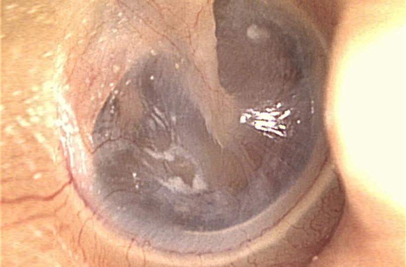 Oído medio - colesteatoma | Cirugía del oído - Servicio de cirugías - Instituto de Cabeza y Cuello (ICiC). Oído medio - colesteatoma | Cirugía del oído - Servicio de cirugías - Instituto de Cabeza y Cuello (ICiC).